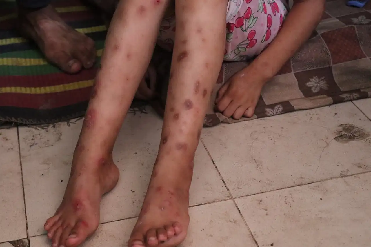 Gazze'de suçiçeği alarmı: Vakalar iki haftada 9 bini aştı