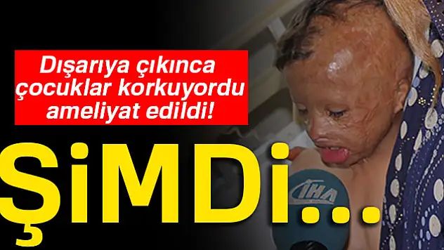 Dışarıya çıkınca çocuklar korkuyordu, ameliyat edildi!