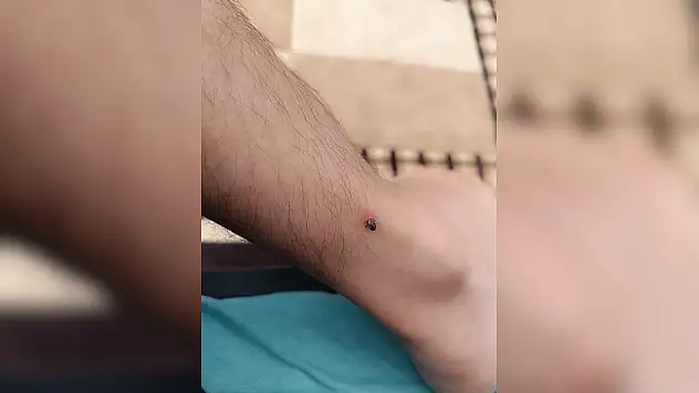 Kayseri'de kene paniği: 1 kişi hastaneye kaldırıldı