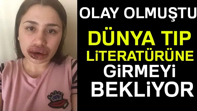 Merve Keleş'in dudakları dünya tıp literatürüne girmeyi bekliyor