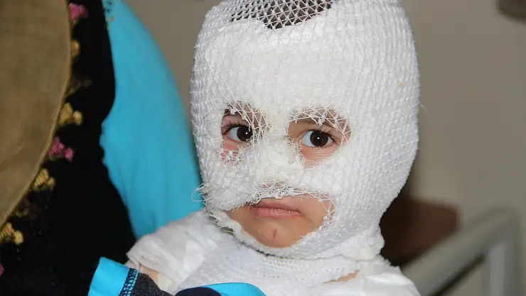 2 YAŞINDAKİ BEBEĞİN ÜZERİNE KAYNAR SU DÖKÜLDÜ,ÖLÜMDEN DÖNDÜ