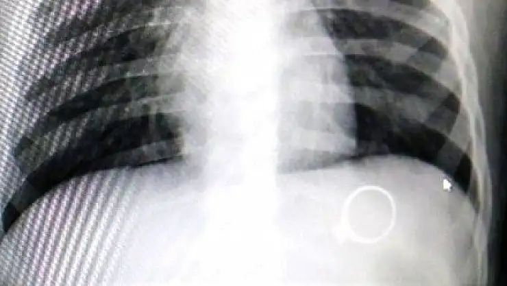 MİNİK BEBEK, ANNESİNİN YÜZÜĞÜNÜ YUTTU