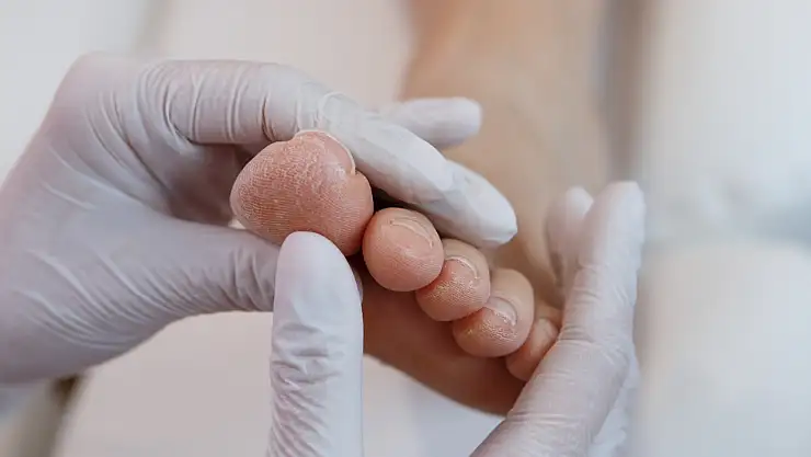 Tırnak batması neden olur? İşte batmayı engellemek için alınacak basit ve kolay önlemler